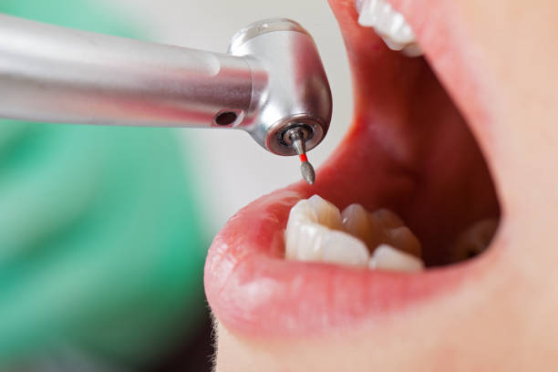 Best Chipped Tooth Repair Near Me  in Marlton, NJ